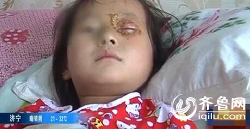 6歲女童被生日蛋糕上的音樂蠟燭炸傷了眼睛，眼角膜燙傷。